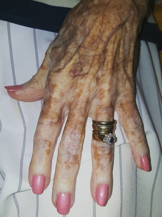 Nurse Takes Photo Of Old Lady’s Hand – Then Sees Detail In The Picture 