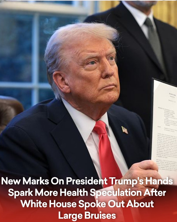 Fresh Marks on President Trump’s Hands Fuel Further Health Concerns Following White House Response to Earlier Bruises