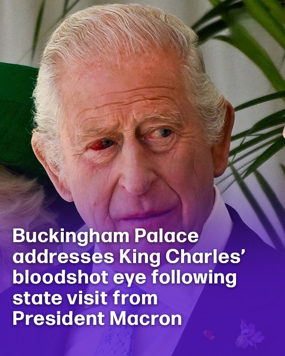 Buckingham Palace addresses King Charles’ bloodshot eye following state visit from President Macron